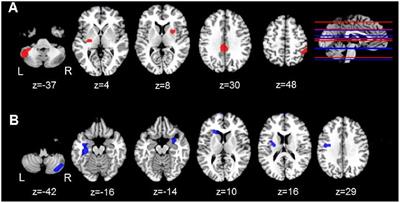 Aberrant Intrinsic Activity and Connectivity in Cognitively Normal Parkinson’s Disease